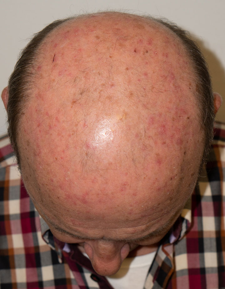 Queratosis actínicas múltiples en el cuero cabelludo de un paciente con daño solar crónico