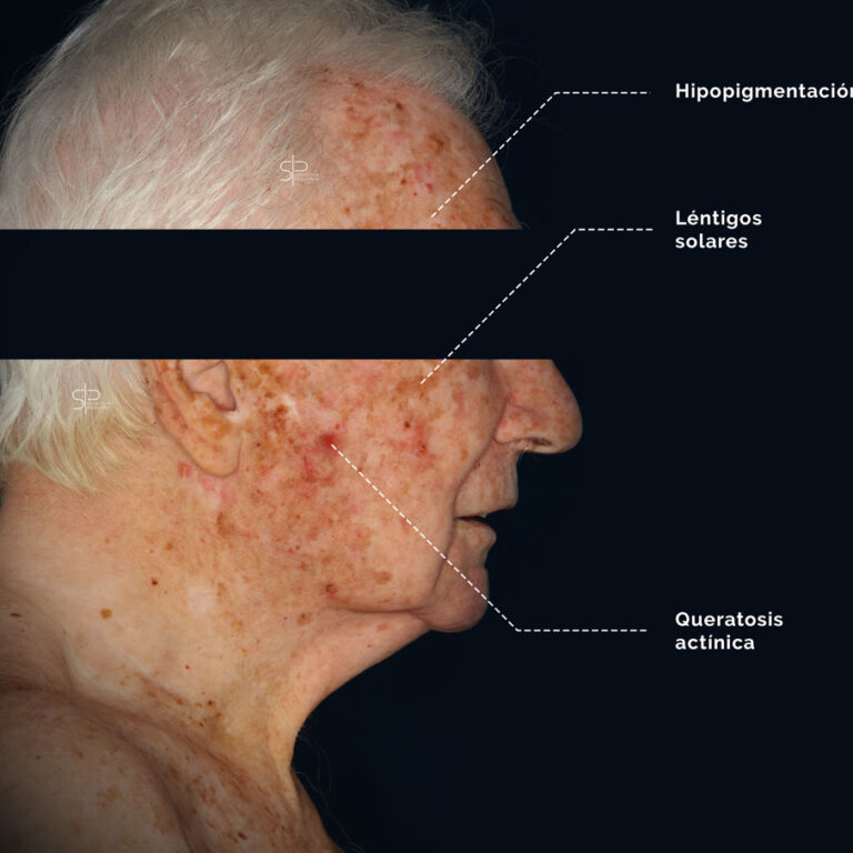 Photos of a patient with chronic actinic damage and multiple actinic keratoses.