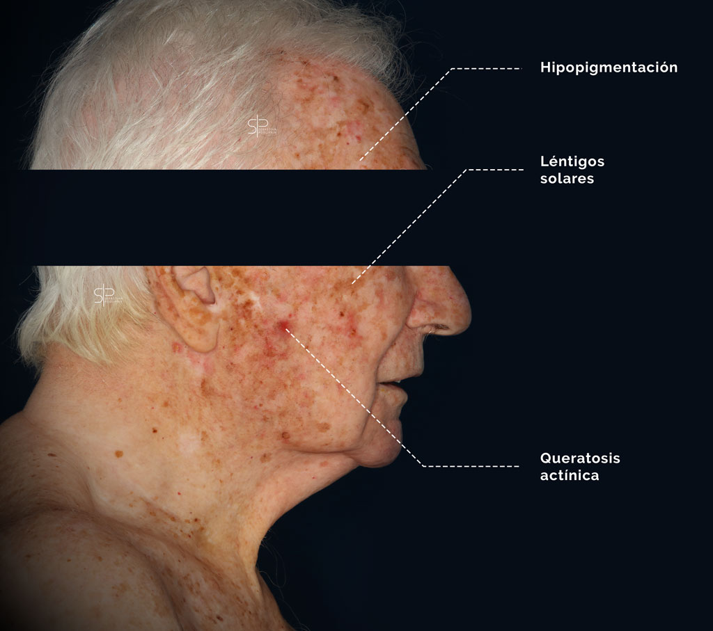 Photos of a patient with chronic actinic damage and multiple actinic keratoses.