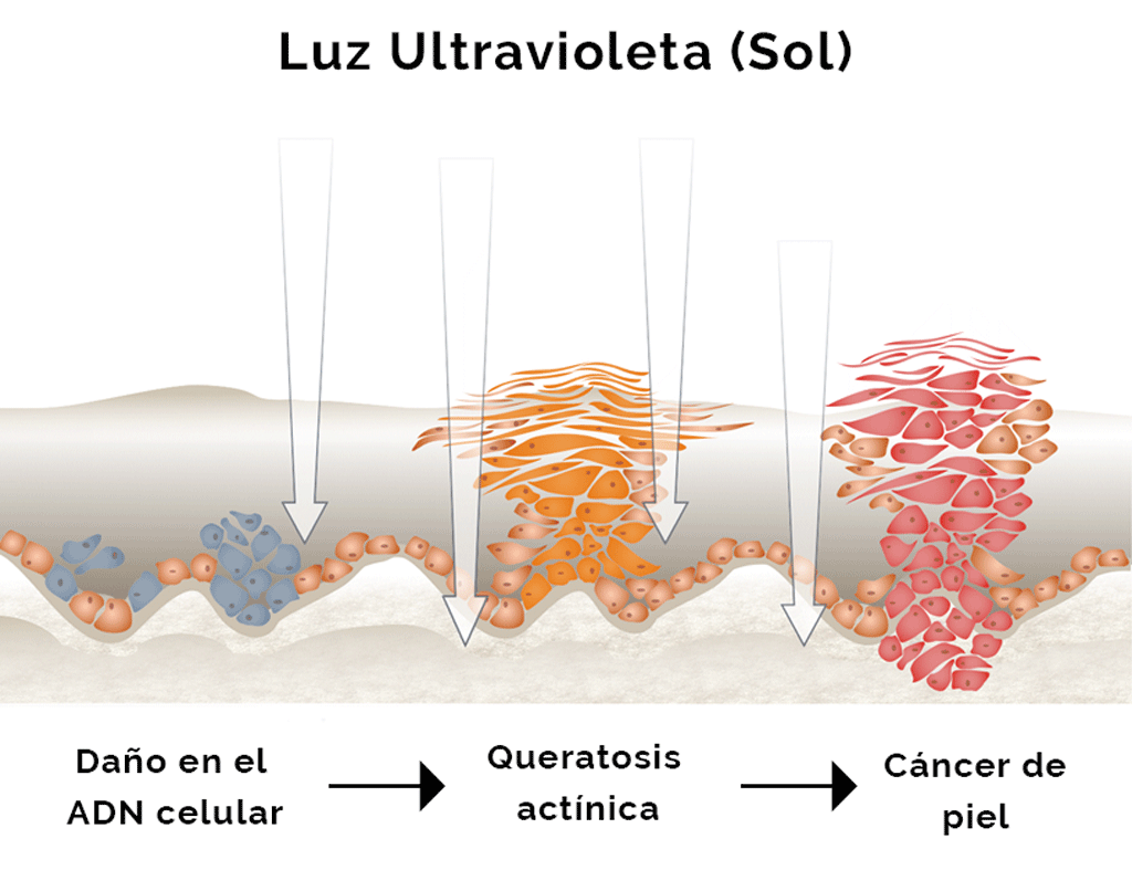 Illustration showing the progression of actinic keratoses to skin cancer.