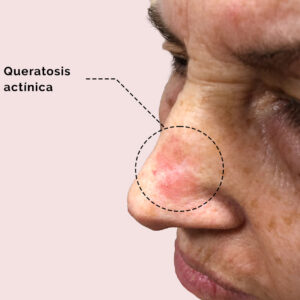 Actinic keratosis on a patient's nose