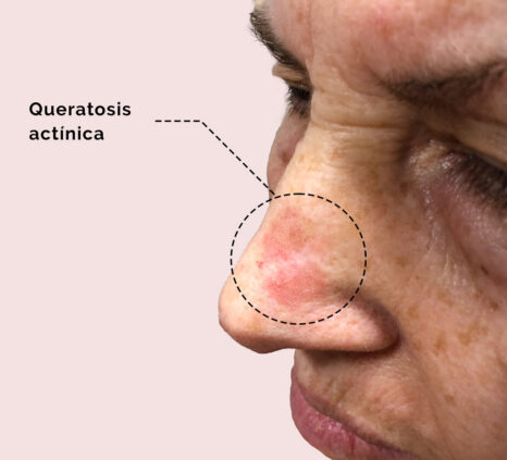 Queratosis actínica en la nariz de una paciente