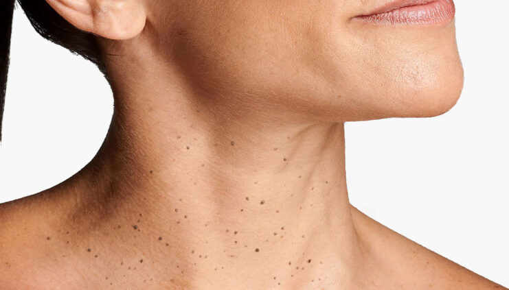 paciente que tiene múltiples verrugas en el cuello o acrocordones