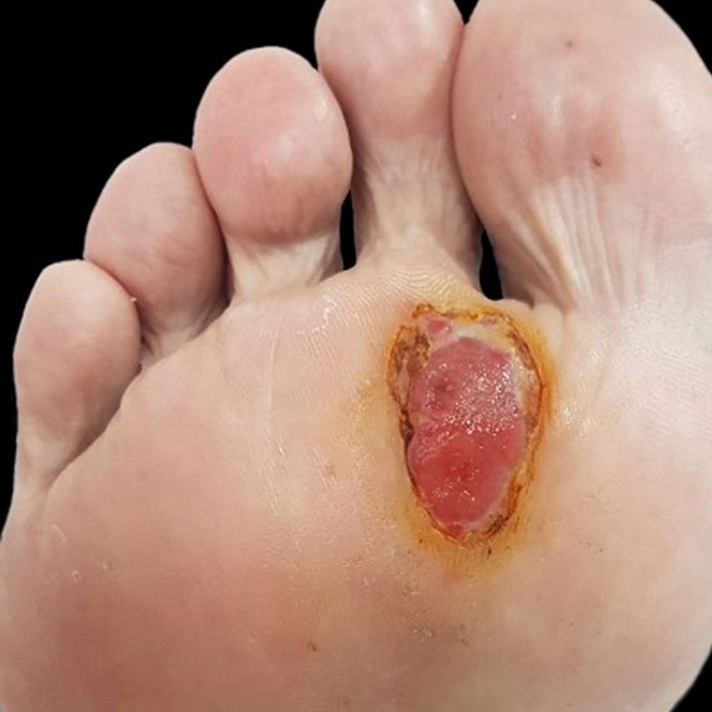 Imagen de un paciente con un melanoma en la planta del pie