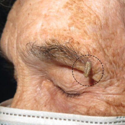 Cuerno cutáneo que ha aparecido en una paciente mayor sobre una queratosis seborreica