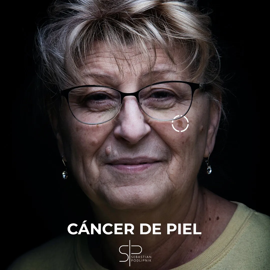 Portrait of an elderly woman with possible facial lentigo maligna maligna type skin cancer.