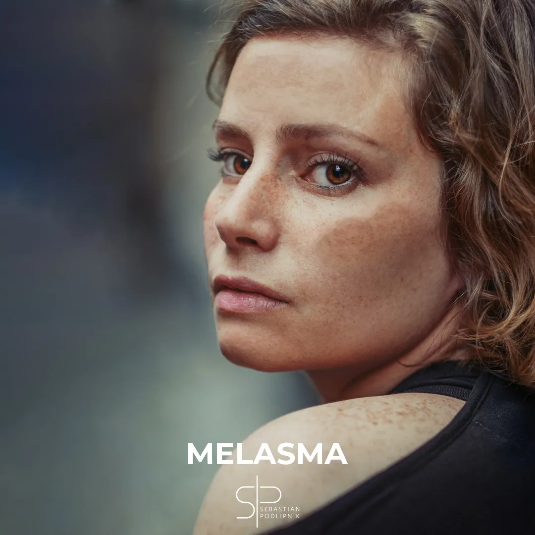 Portrait of a young woman with melasma