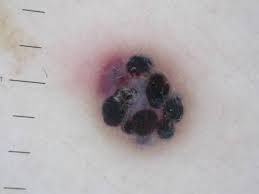 Angiokeratoma that may manifest as a red mole