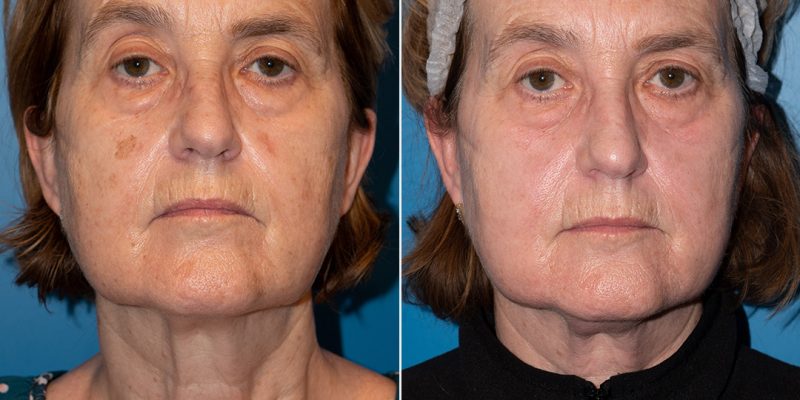 Antes y después de una paciente que se ha realizado láser de luz pulsada intensa para quitar las mandas de la cara