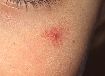 Vascular spider on the face of a young patient resembling a red mole