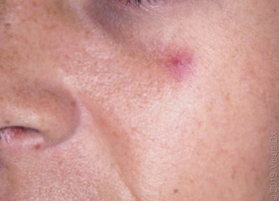Vascular spider on a woman's cheek