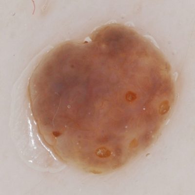 Dermoscopy of seborrheic keratosis or crusted mole