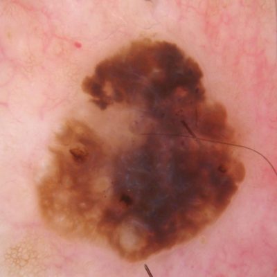Dermoscopy of seborrheic keratosis or crusted mole