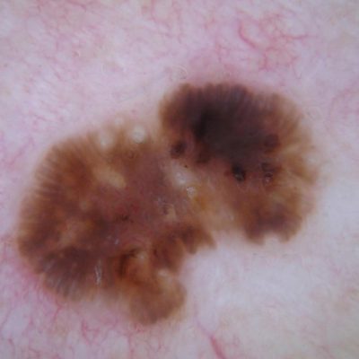 Dermoscopy of seborrheic keratosis or crusted mole